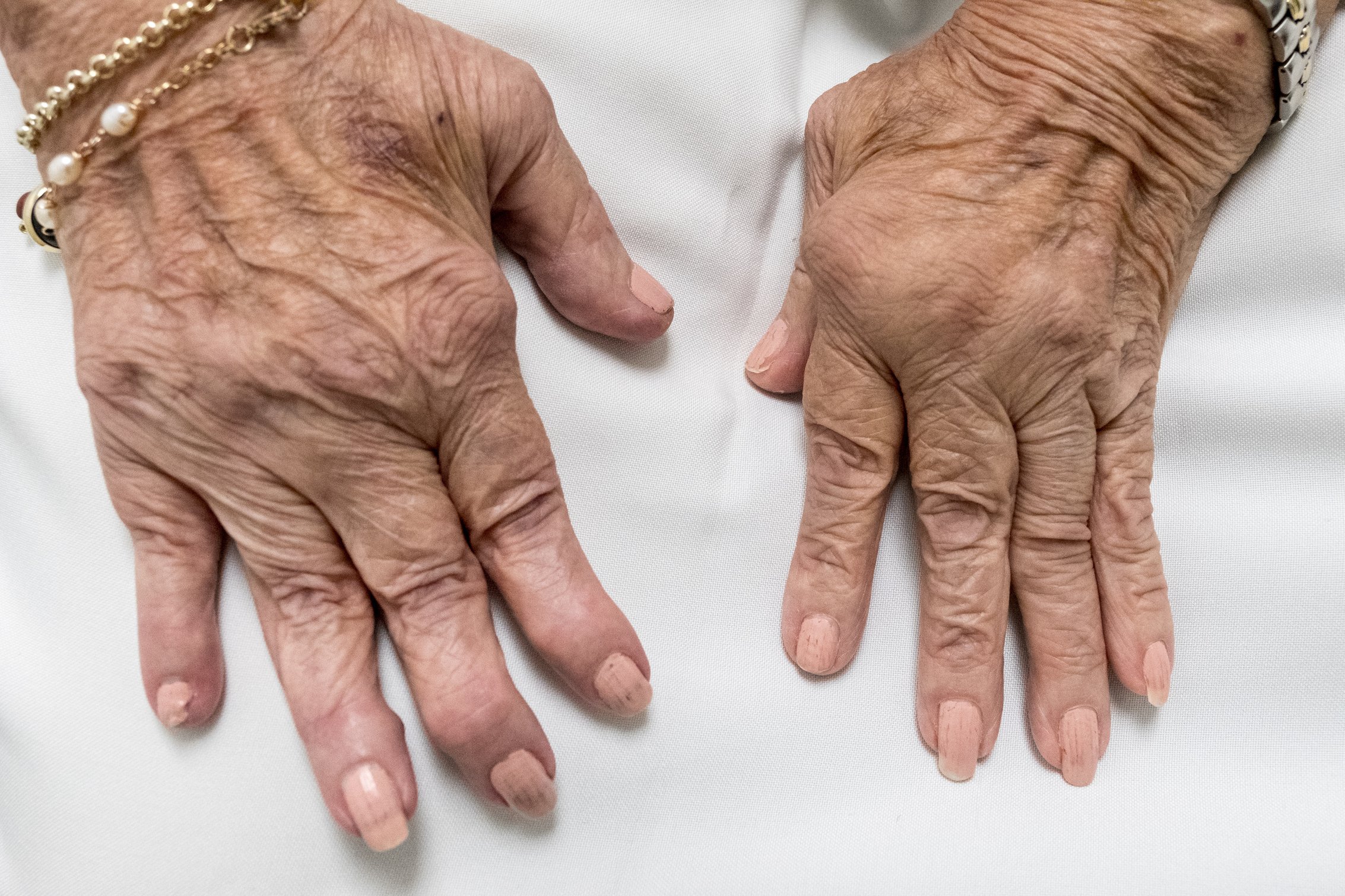 Rheumatoid Arthritis - Hands