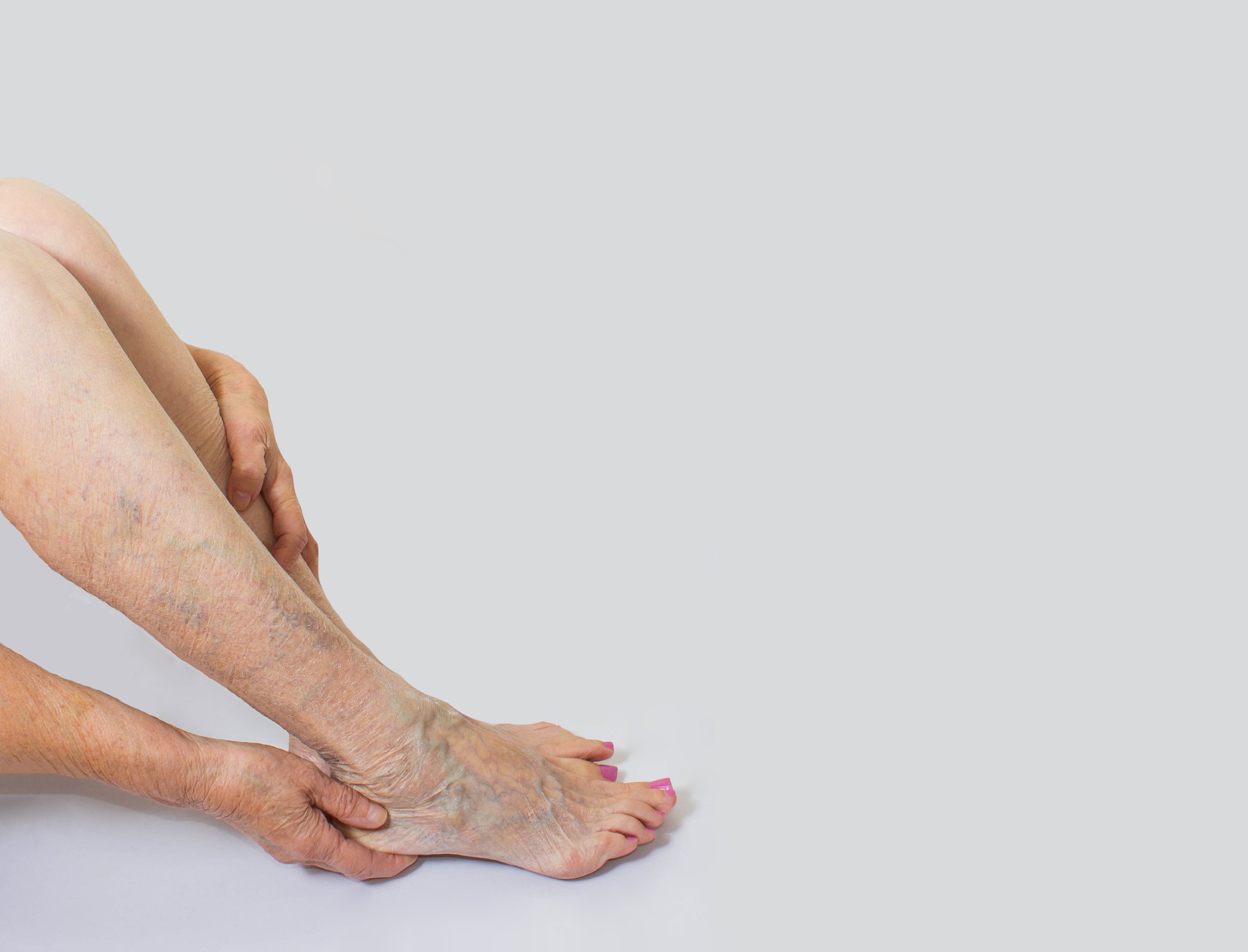 Varicose veins on a female legs