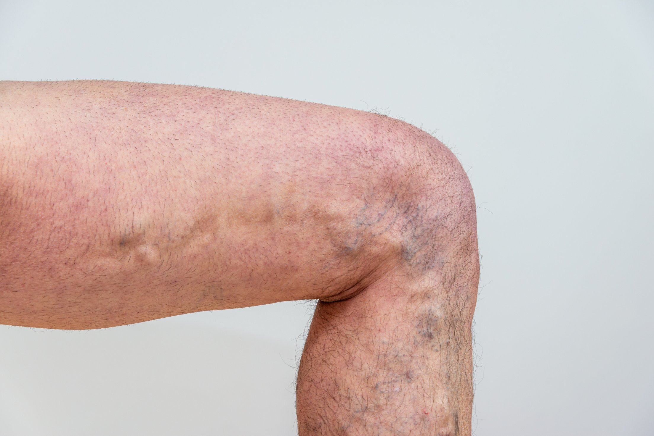 Varicose Vein on elderly male legs on white background .